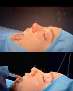 Image of Rhinoplasty