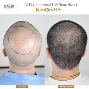 Image of BEQ Clinic - Dr. Danai Bangkok Hair Transplant Gallery 3