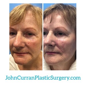 Image of MD.John Curran Plastic Surgery Gallery 2