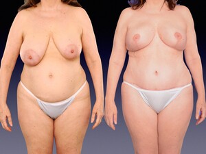 Image of Center for Restorative Breast Surgery Gallery 0