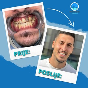 Image of Hollywood smile makeover-  Micunovic medical