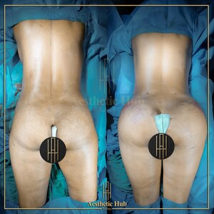 Image of BBL with 360 Liposuction - Aesthetic Hub Turkey