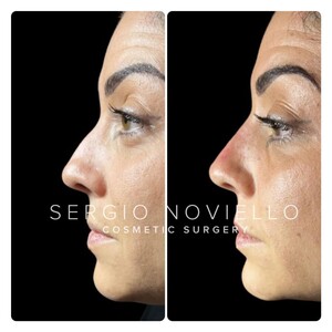 Image of Rhinoplasty