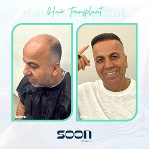 Image of Hair transplantation