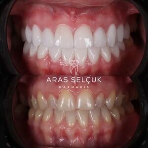 Image of Porcelain veneers - Aras Selçuk Marmaris Dental Clinic