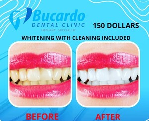 Image of Teeth whitening