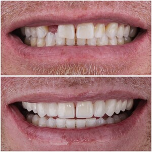 Image of Porcelain veneers