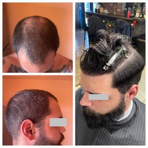 Image of Hair transplant - Bendis Clinic