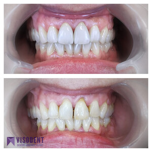 Image of Teeth whitening