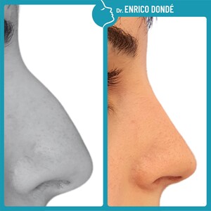 Image of Rhinoplasty before and after