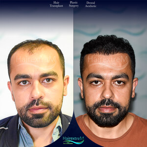 Image of HairextreM Hairtransplant Center Gallery 2