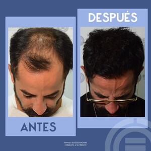 Image of Hair transplantation