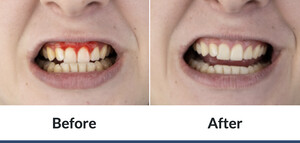 Image of Gum treatment