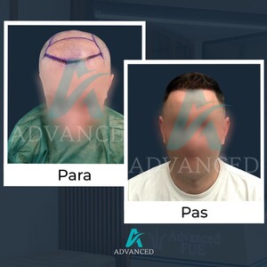 Image of Advanced Hair Transplant Gallery 2