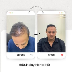 Image of Hair loss treatment before and after