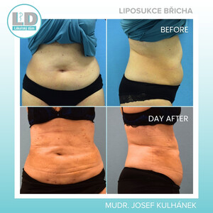 Image of Liposuction - LD Clinic Prague