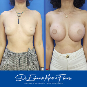 Image of Breast augmentation