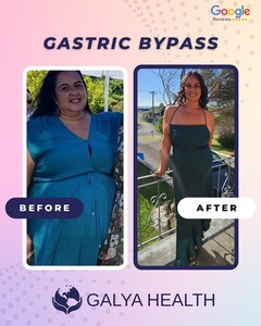 Image of Gastric bypass