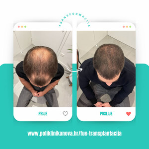 Image of Hair transplant