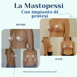 Image of Mastopexy - Dr Lorenzo Cali Cassi 