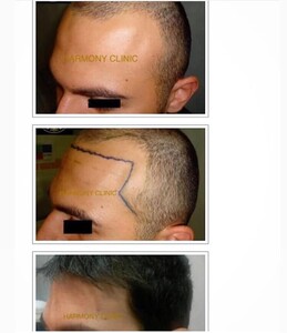 Image of Hair transplant process