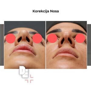 Image of Nose job