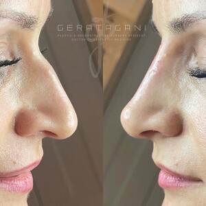 Image of Nose job - Dr Gera Tagani