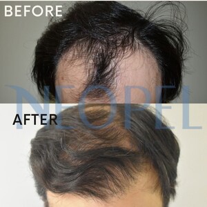 Image of Before and after hair transplant