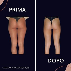 Image of Liposuction for glutes