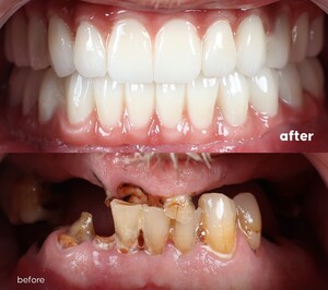 Image of Full smile makeover