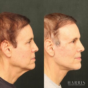 Image of Facial plastic surgery