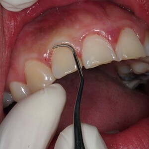 Image of Teeth cleaning