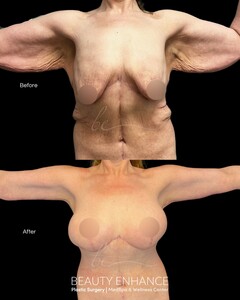 Image of Before and after body lift