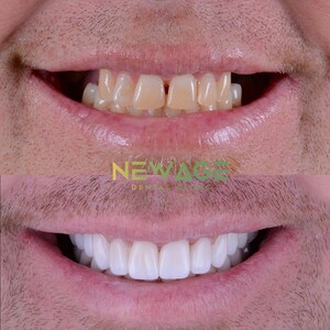 Image of Teeth whitening