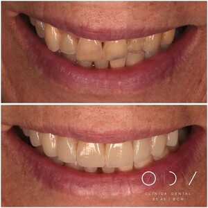 Image of Teeth whitening