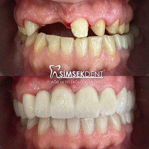 Image of Dental Implants - Şimşek Dent