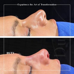 Image of Rhinoplasty results