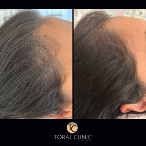 Image of Hair loss treatment