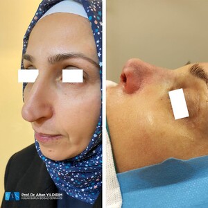 Image of Before and after Rhinoplasty