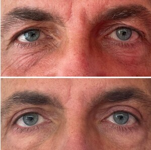 Image of Eyelid surgery