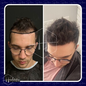 Image of FUE hair transplant - Healstetic Clinic