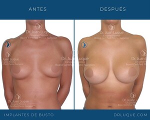 Image of Breast implants