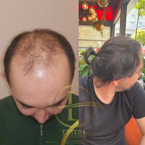 Image of Esteda Hair Hospital - Hair Transplant Turkey Gallery 2