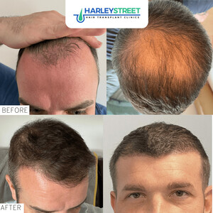 Image of Harley Street Hair Transplant Clinics Gallery 3