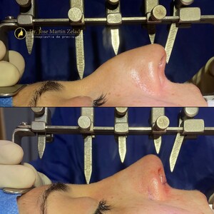 Image of Rhinoplasty