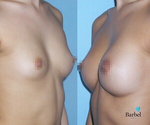 Image of Breast augmentation - Barbel Polyclinic