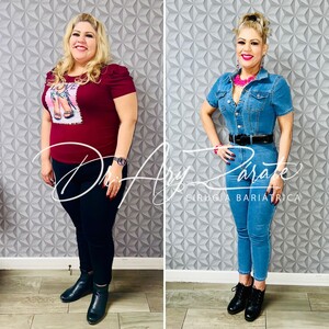 Image of Before and after gastric sleeve