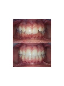 Image of Dental crowns - Dentelli