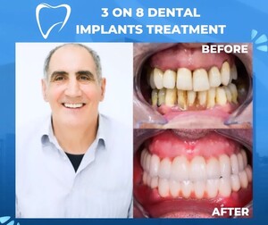 Image of Dental Implants