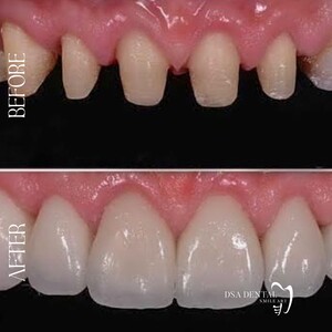 Image of Zirconium crowns